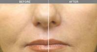 Chicago Laser Wrinkle Reduction